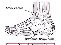 Bursitis aquílea