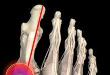 Hallux Valgus