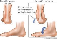 Excesiva pronación y arcos bajos (insuficiencia del arco longitudinal)