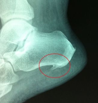 Fascitis plantar espolon