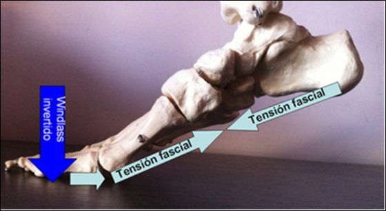 Fascitis plantar tension